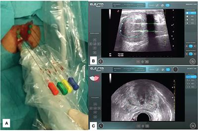 Standard approach and future perspective for the management of benign prostatic hyperplasia from a health-economics point of view: the role of transperineal laser ablation